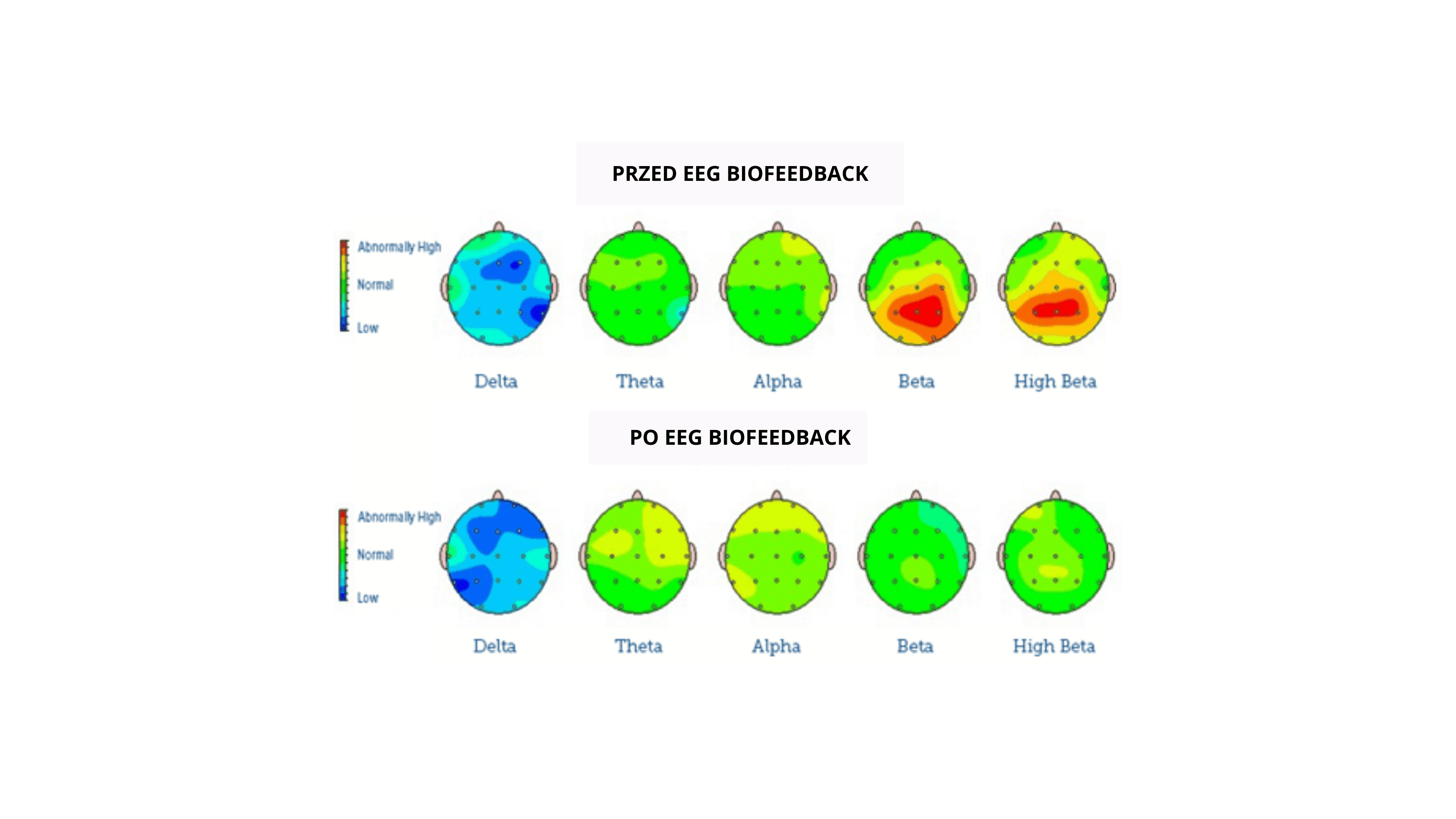mapa mózgu przed i po terapii EEG